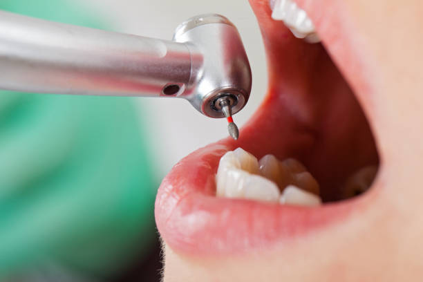 Best Emergency Wisdom Tooth Extraction in Gate City, VA